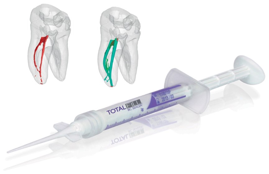 TotalFill BC Sealer – revolucionaren dvofazni biokeramični