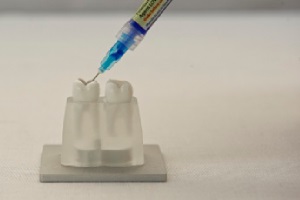 FotoSan630 razkuževanje endodontskega kanala korak 4