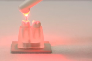 FotoSan630 razkuževanje endodontskega kanala korak 5