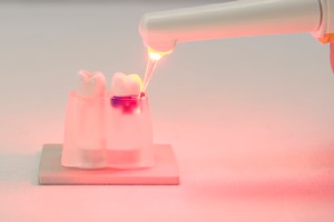 FotoSan630 zdravljenje periodontitisa korak 4