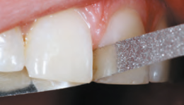 Diamantni trakci